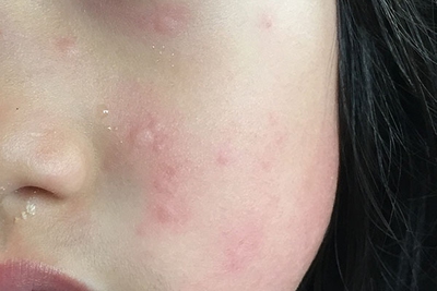 cold urticaria on face
