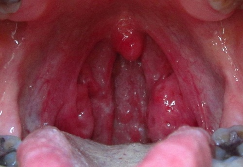 in Recurring sore adults throat