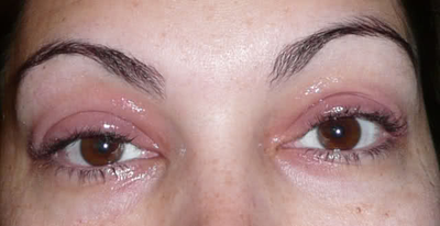 Mascara Allergy: Cause, Signs Treatment EnkiVeryWell