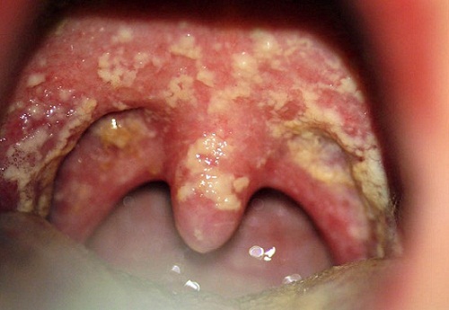 Ray Eksempel venskab 8 Most Common Causes of White Spots on Throat (with Pictures) - EnkiVeryWell