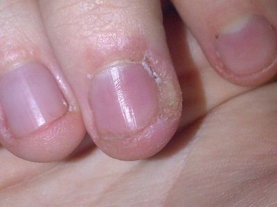 Why Is the Skin Around Your Nails Peeling? - EnkiVeryWell