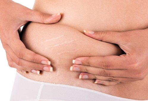 How To Get Rid Of Purple Stretch Marks For Good – Dermaclara